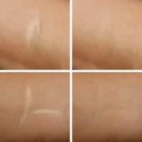 Scars | Meo Skin Repair in Dusseldorf