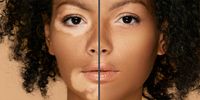 Treatment Pigment Spots | Meo Skin Repair in Dusseldorf