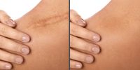 Treatment Scars | Meo Skin Repair in Dusseldorf