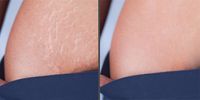 Treatment Stretch Marks | Meo Skin Repair in Dusseldorf